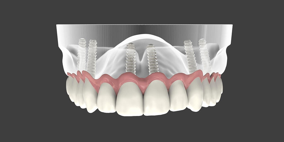 Best Dentures To Get Metairie LA 70001